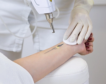 Indian patient consulting for tattoo removal