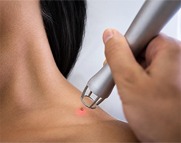 Indian patient consulting for wart removal treatment